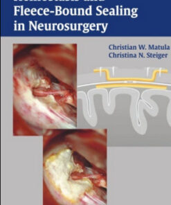 Hemostasis and Fleece-Bound Sealing in Neurosurgery