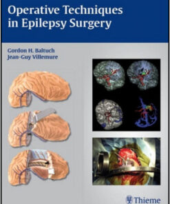 Operative Techniques in Epilepsy Surgery