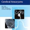 Flow Diversion of Cerebral Aneurysms 1st Edition PDF