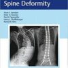 Neuromuscular Spine Deformity PDF