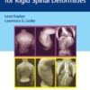 Corrective Osteotomies for Rigid Spinal Deformities