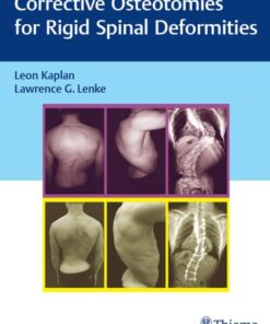 Corrective Osteotomies for Rigid Spinal Deformities