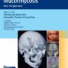 Invasive Skull Base Mucormycosis